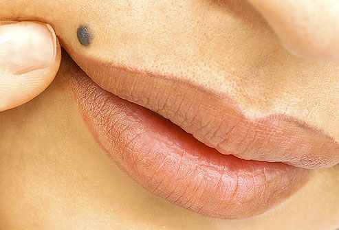 تشخیص خال های سرطانی - مجله تصویر زندگی