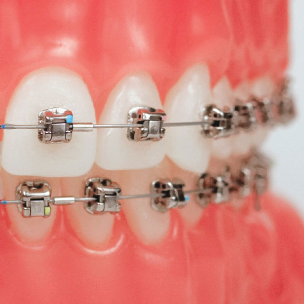 Damon Braces