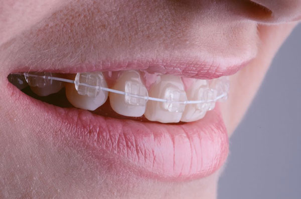 ceramic braces