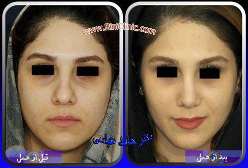 عمل بینی گوشتی