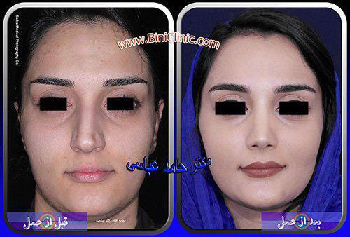 جراحی بینی ترمیمی