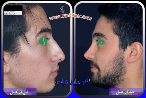 عمل بینی فانتزی