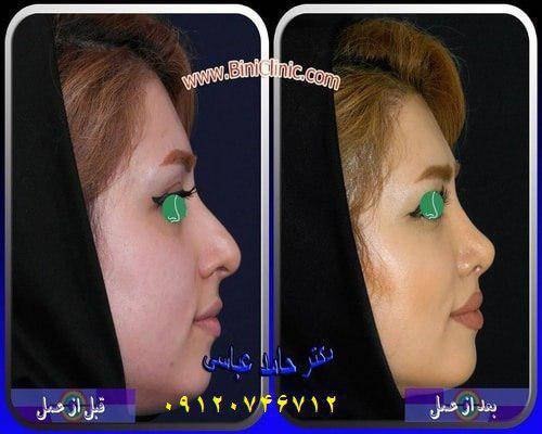 جراحی بینی قبل و بعد از عمل زیبایی