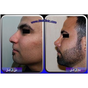 قبل و بعد از عمل بینی آقایان