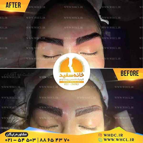 نمونه کاشت ابرو در کلینیک خانه سفید