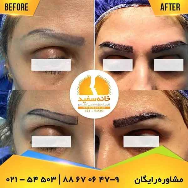 نمونه کاشت ابرو در کلینیک خانه سفید