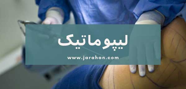 عمل لیپوماتیک