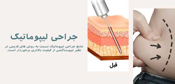 عمل لیپوماتیک