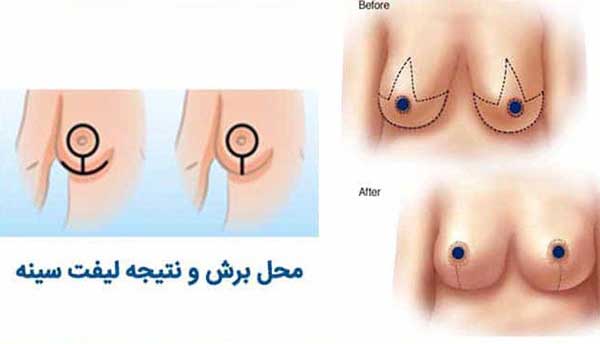 عمل لیفت سینه