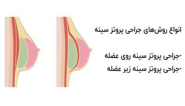 انواع روش های پروتز سینه