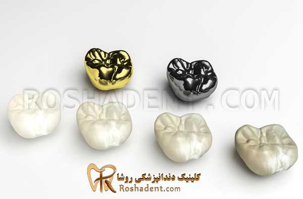روکش دندان
