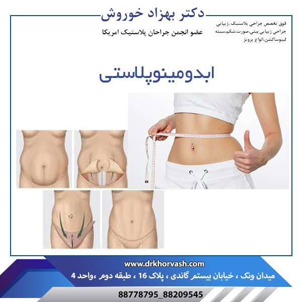 ابدومینوپلاستی