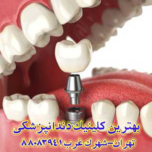 هزینه کاشت دندان