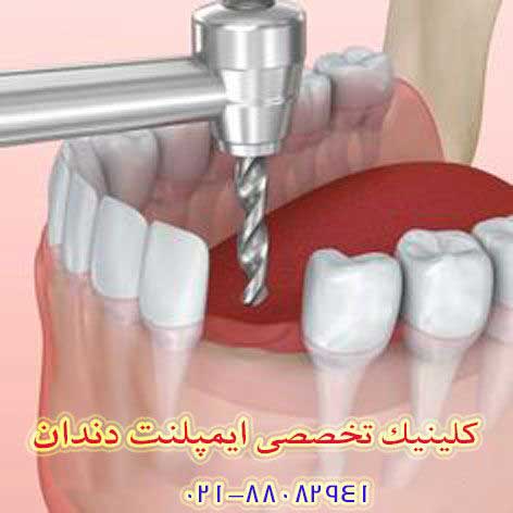 هزینه کاشت دندان