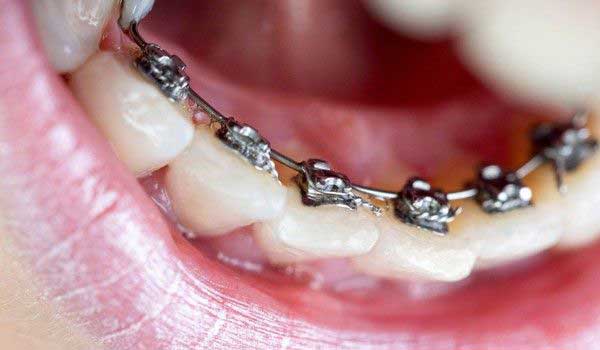 بهترین نوع ارتودنسی کدام است