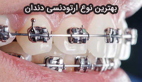 بهترین نوع ارتودنسی دندان