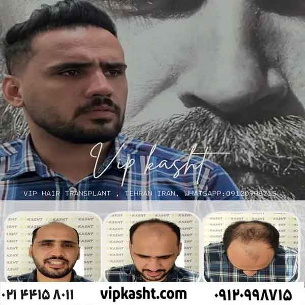 کاشت مو دائمی