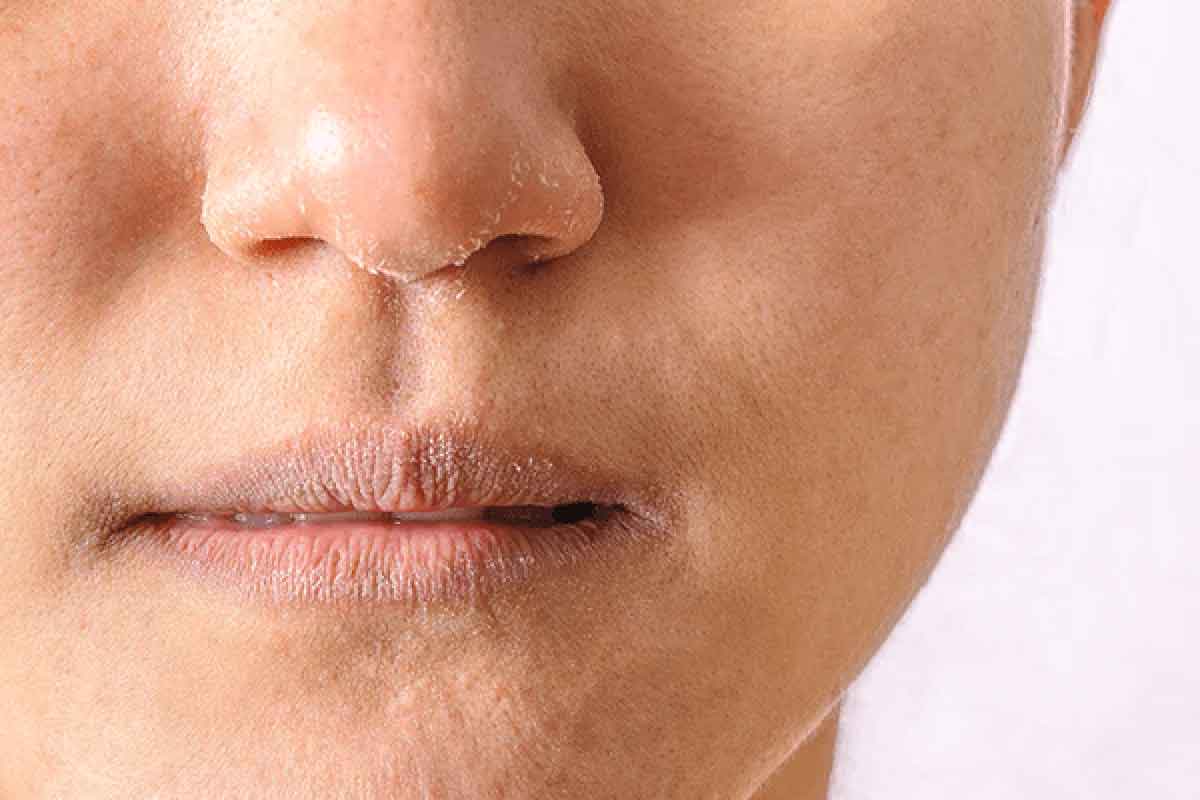 ویژگی های پوست خشک