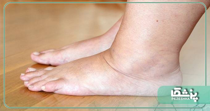 علل ابتلا به سیروز کبدی