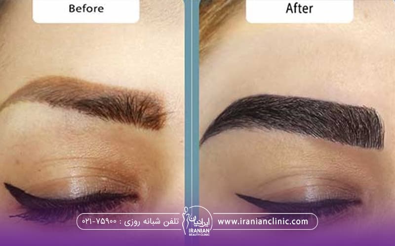 عکس قبل و بعد زنی که کاشت ابرو انجام داده است