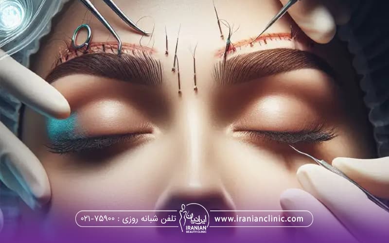 فردی که خوابیده و پزشکان در حال پیوند فولیکول ها به ابروی او می باشند