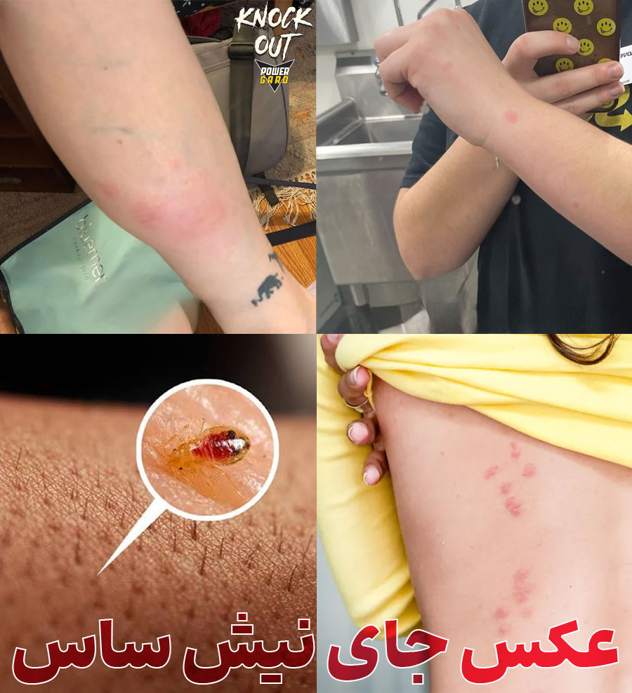 عکس جای نیش ساس در بدن