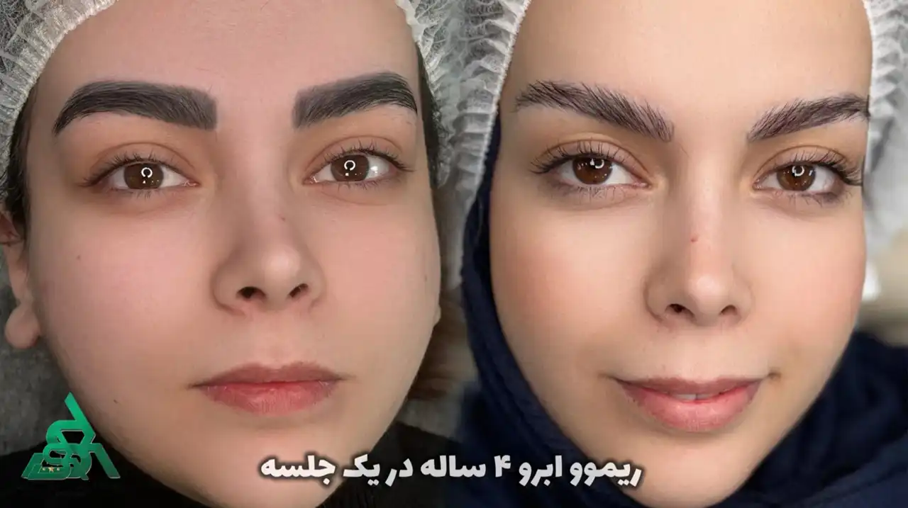 قبل و بعد از ریموو تاتوی کادری ابرو در آکادمی ساغر کشاورز