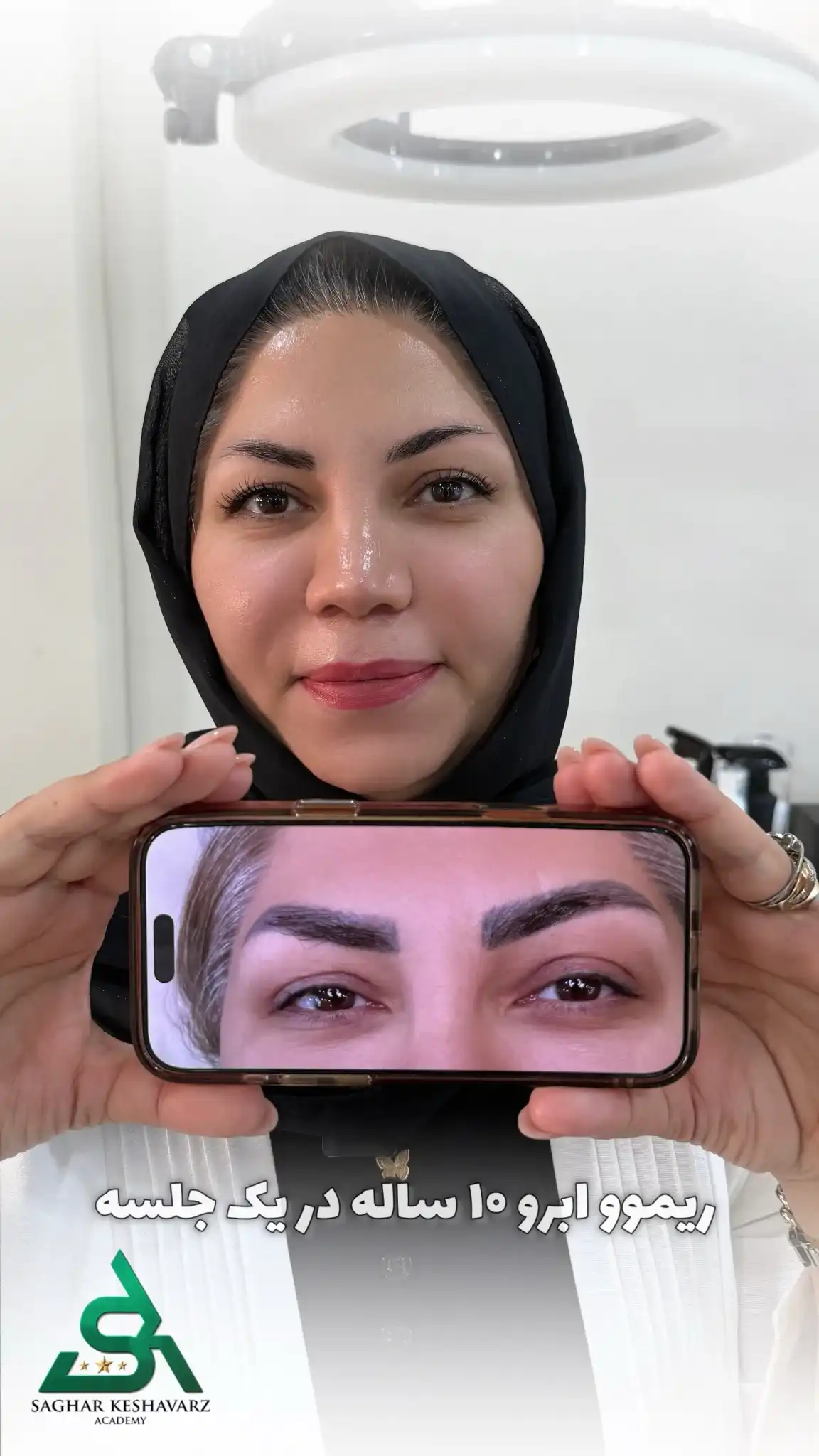 نمونه ریموو تاتوی ۱۰ ساله ابرو در آکادمی ساغر کشاورز