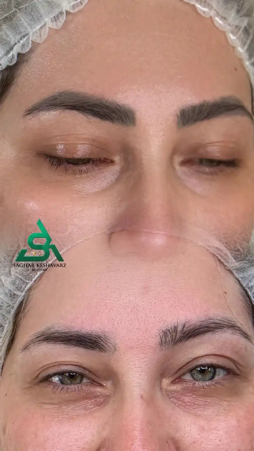 مقایسه ابرو قبل و بعد از ریموو تاتوی ۶ ساله