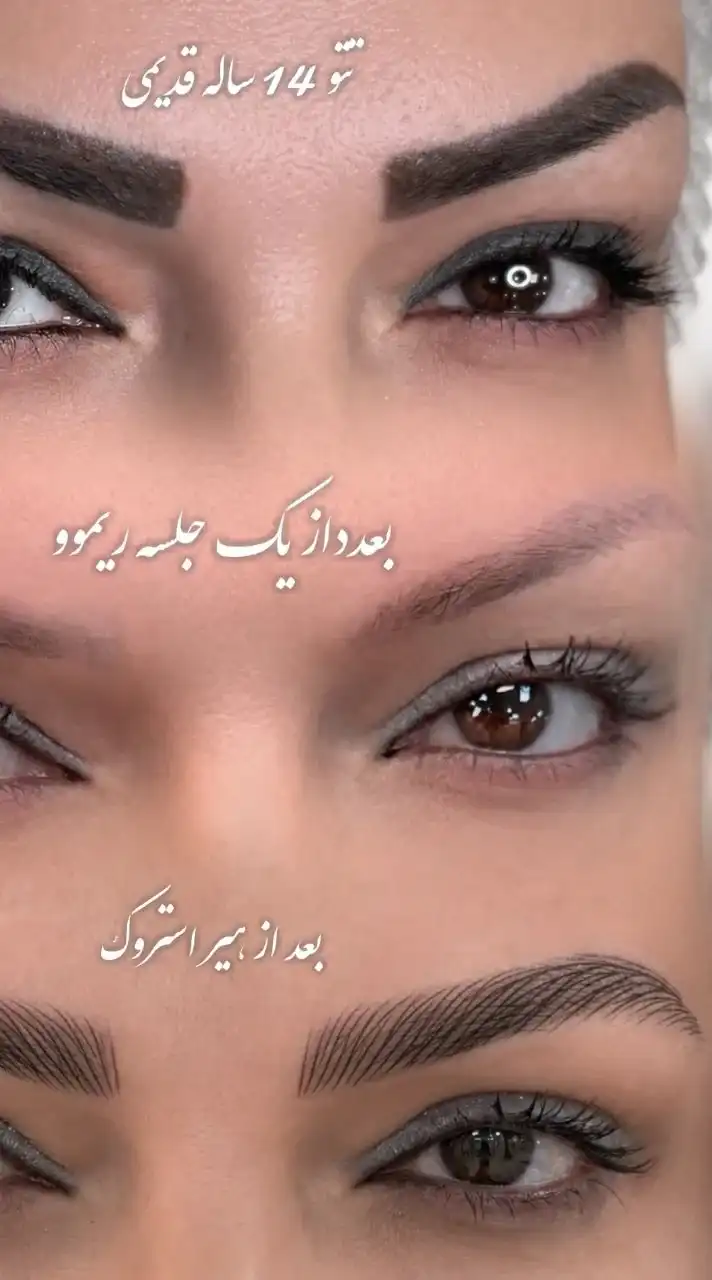 مراحل ریموو تاتوی قدیمی ابرو و اجرای لاین استروک پس از آن