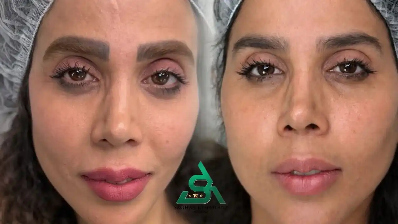 ریموو تاتوی کادری ابرو