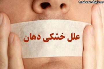 علل خشکی دهان چیست و چه نشانه هایی دارد ؟