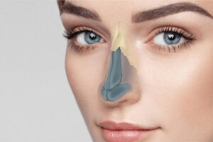 Rhinoplasty
