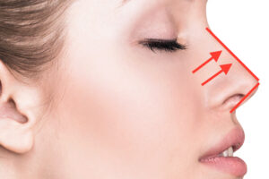 nose-thread-lift