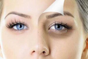 از بین بردن سیاهی دور چشم
