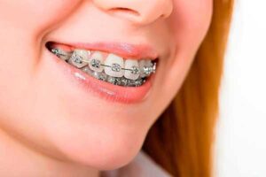 Orthodontics treatment