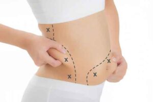 tummy-tuck