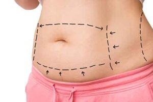 tummy tuck