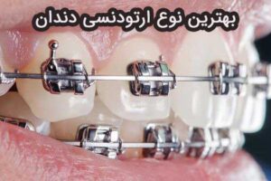 بهترین نوع ارتودنسی دندان