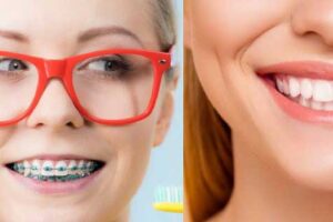 Laminate is better or orthodontics