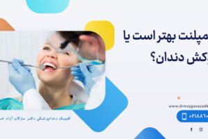 ایمپلنت بهتر است یا روکش دندان؟