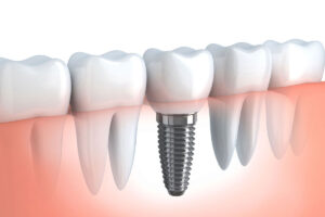 Dental-implant