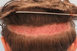 hair transplant