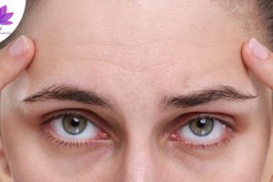 چرا بعد از 30 سالگی چروک‌های ریز بیشتر دیده می‌شوند؟