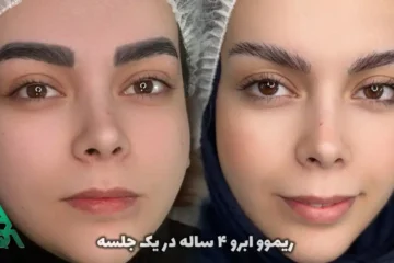 قبل و بعد از ریموو تاتوی کادری ابرو در آکادمی ساغر کشاورز