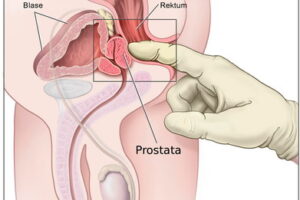 prostat